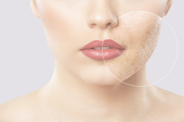 Acne Tool Collection