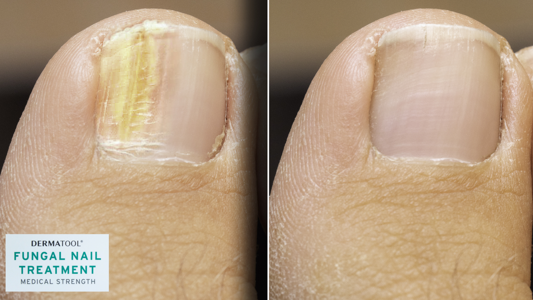 Nail Fungal Treatment Cardiff | LaserWise Clinic